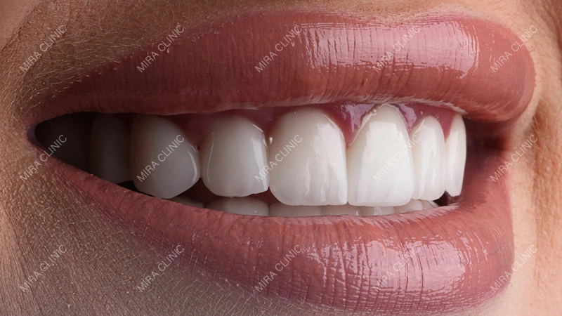 Dental Veneers